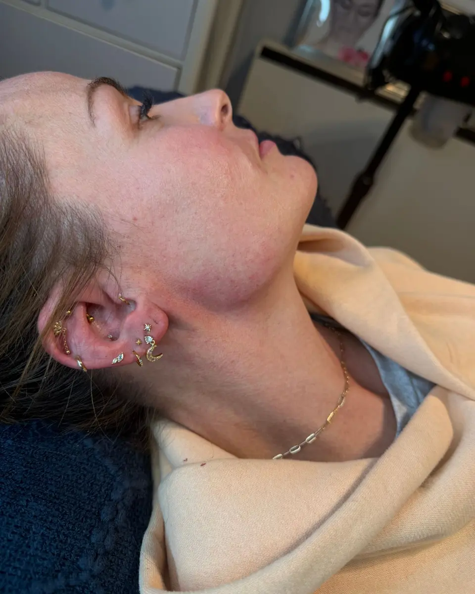 Side profile of a client's jaw and cheek on the treatment couch