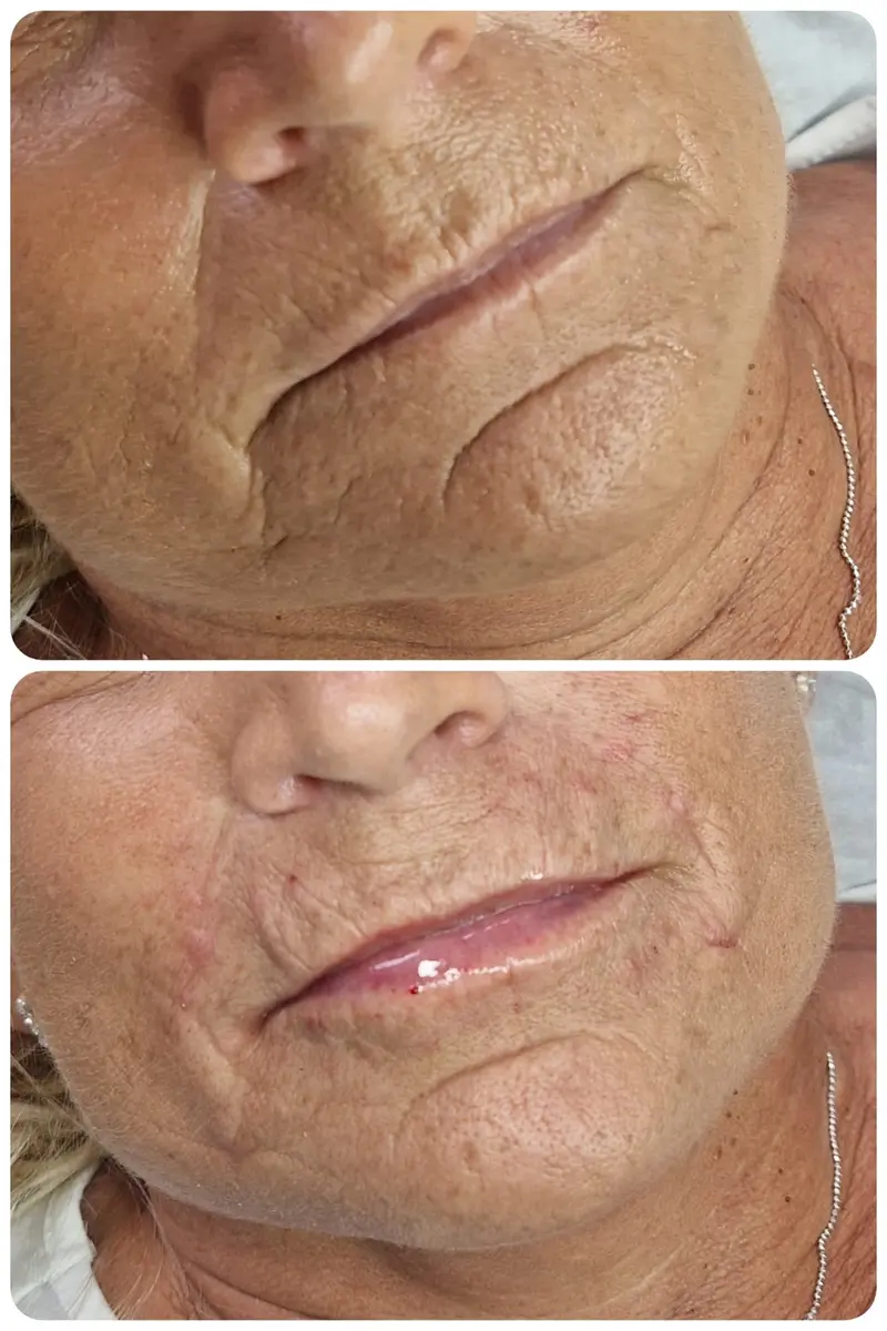 Before (top) and after (bottom) lip and nasolabial fold filler: fuller, more defined lips and softer lines from the nose to the mouth